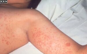 Measles Cases