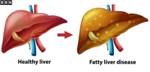 Semaglutide Shows Major Promise in Treating Serious Liver Disease